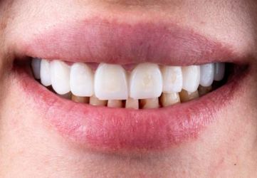 Pediatric Dental Care